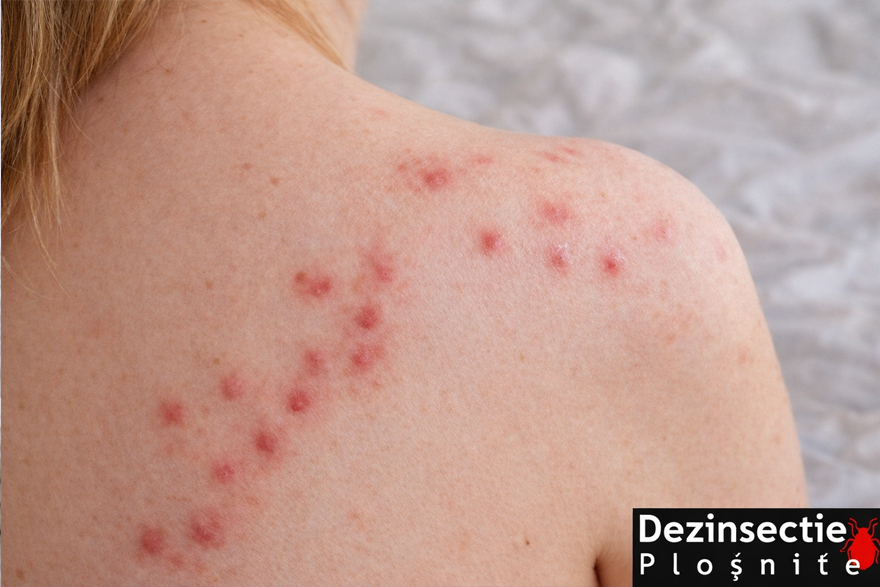 muscaturi plosnite semne pe piele aparute dimineata